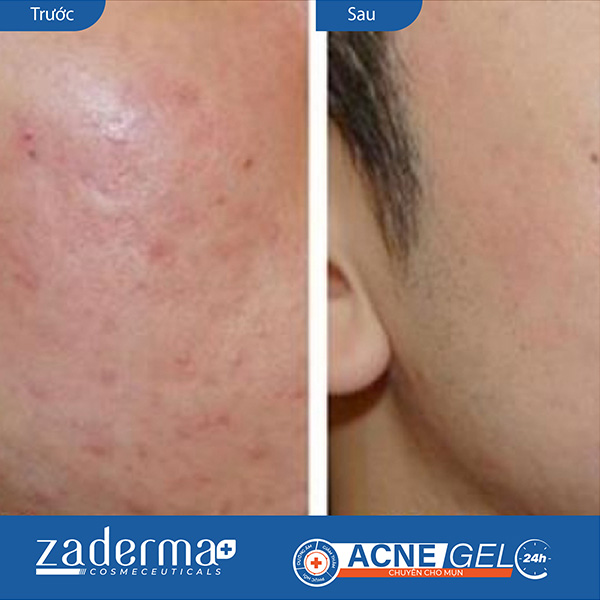Kết quả trước và sau khi sử dụng Zaderma Acne Gel