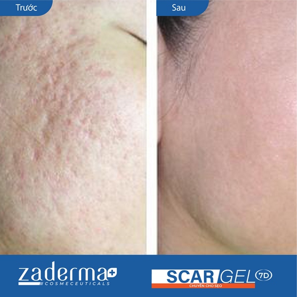 Kết quả trước và sau khi sử dụng Zaderma Scar Gel