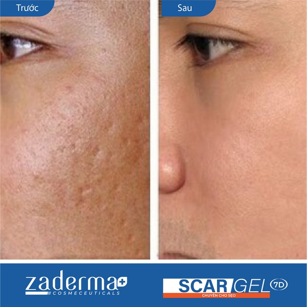 Kết quả trước và sau khi sử dụng Zaderma Scar Gel